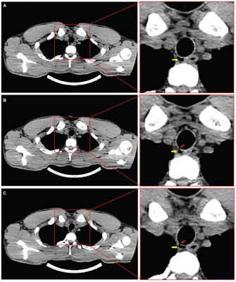 Case report: tracheobronchial diverticulum, a potential risk for diving?